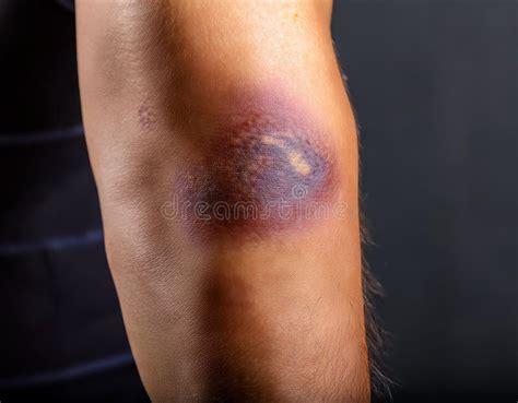 bruise   stages  healing   arm portraying  healing