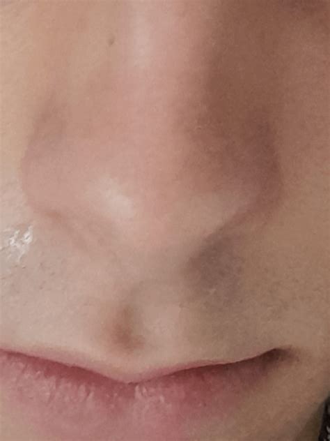 Any idea what this lip rash is called/is? Any advice on how to treat it ...