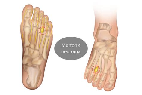 Is Morton's Neuroma Surgery Worth it? - Foot & Ankle Institute of New ...