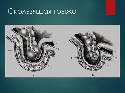 Грыжи живота. Осложненные грыжи. Диагностика и хирургическая тактика ...