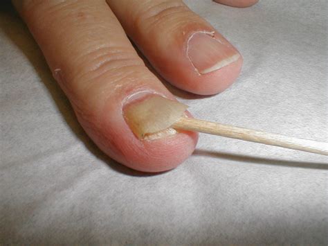 Onycholysis