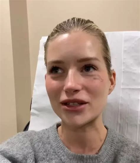 Lottie Moss gets face tattoo removed after drunkenly getting word inked ...