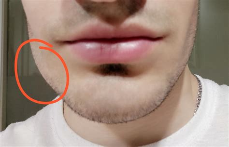 Painful Knot On Jawline at Andy Cruz blog