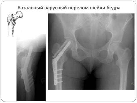 Повреждение бедра - презентация онлайн