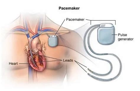 Pacemaker Implantation Surgery in Navi Mumbai | ID: 19269005288