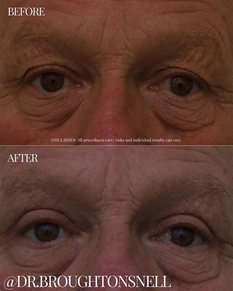 Dr Snell’s patient before and after bilateral blepharoplasty of upper