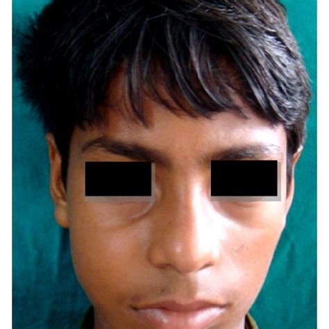 swelling    cheek region  scientific diagram