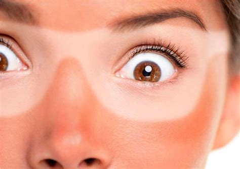 Sunburn: Dealing With The Sunburn - melano