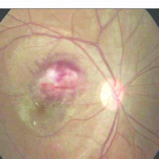 Case 2, fundoscopic examination. | Download Scientific Diagram