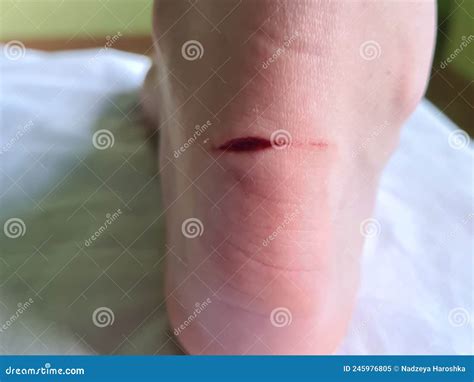 Deep Cut On Leg