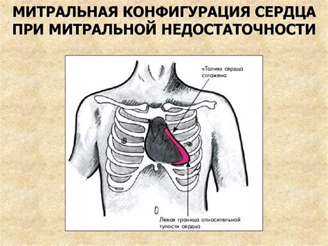 Митральные пороки сердца - презентация онлайн