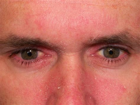 mild seborrheic dermatitis