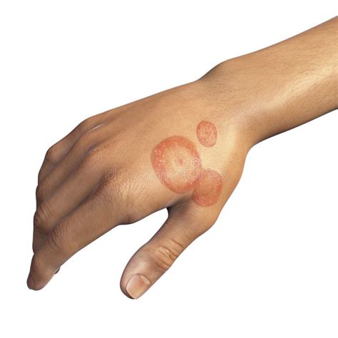 Fungal Infection on a Man S Hand. Tinea Manuum Stock Illustration ...