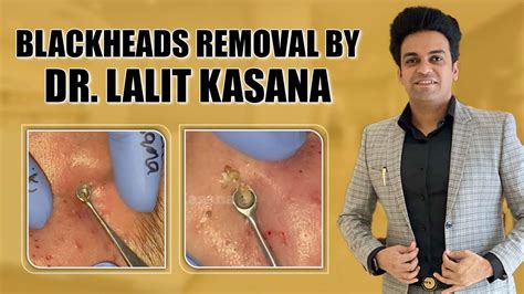 What Industry Experts Say About Unbelievable Blackhead Removal 2024 - bii5a3s
