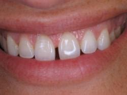 teeth whitening and thin enamel