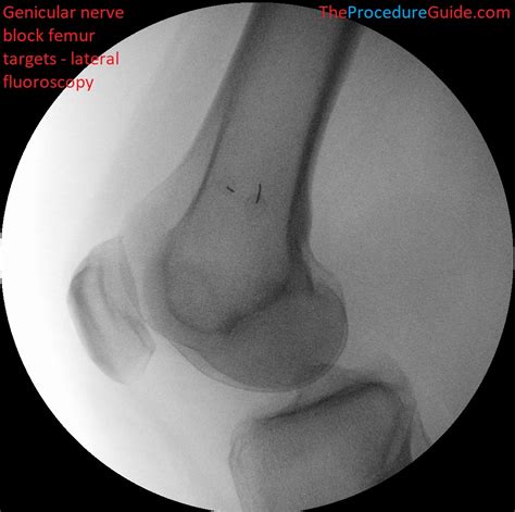 Fluoroscopic Guided Knee Genicular Nerve Block - Technique and Overview ...
