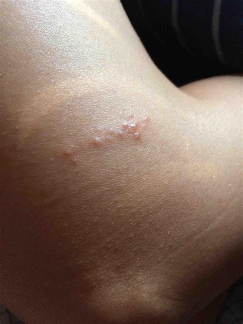 Looks like a line of bumps/blisters. right above knee. : r/MedicalHelp