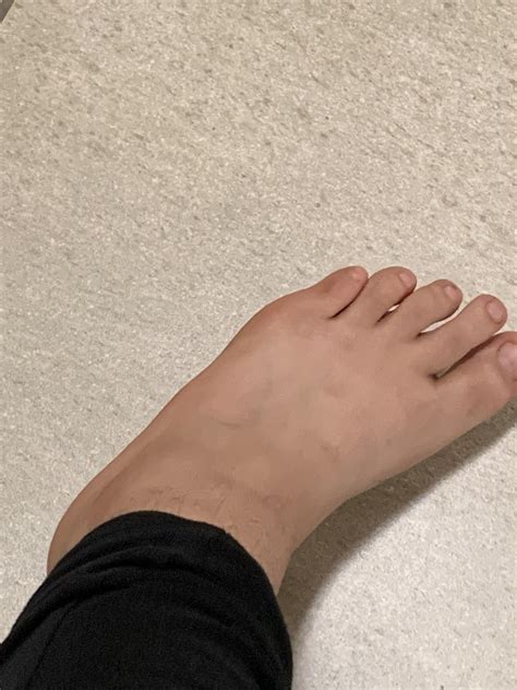 Fell on ankle. Can’t tell if it’s broken, twisted or sprained : r/medical