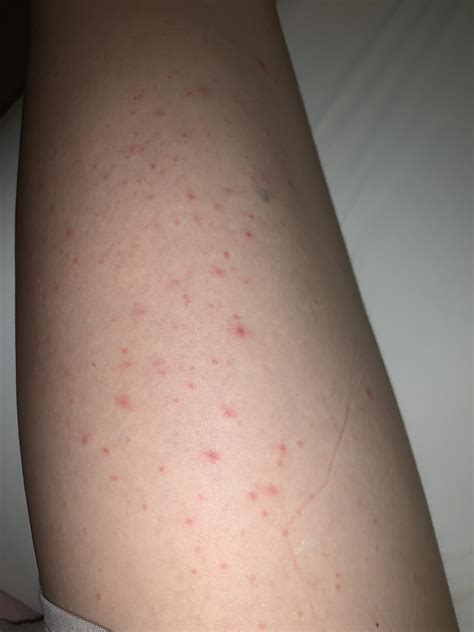Red Bumps On Legs Red Spots On Skin: 19 Common Causes