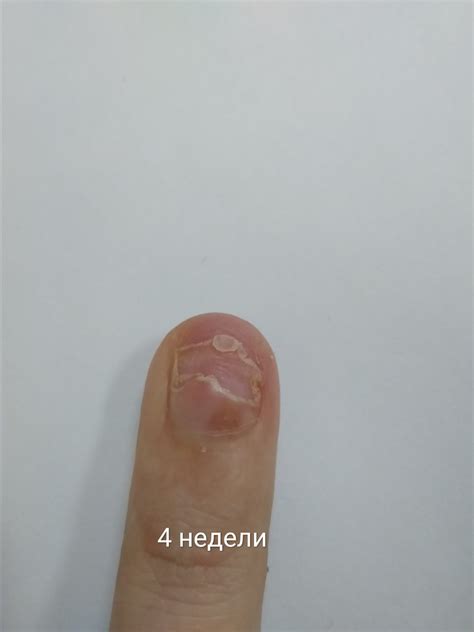 Не прирастает ноготь(онихолизис?) - Вопрос дерматологу - 03 Онлайн