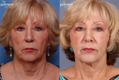 facelift surgery deep plane facelift qayo
