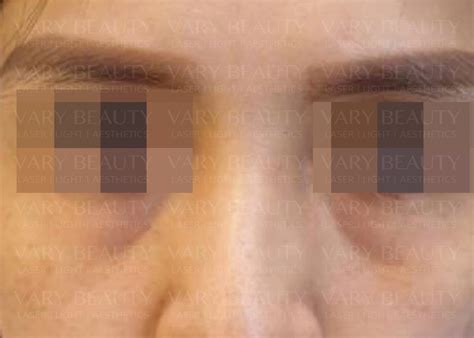 Stem Cell Filler Pen - Vary Beauty