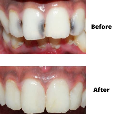 teeth filling services  cranston ri dental ri