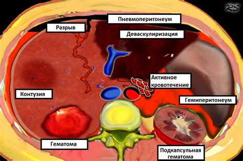 Тупая травма печени: классификация AAST — 24Radiology.ru