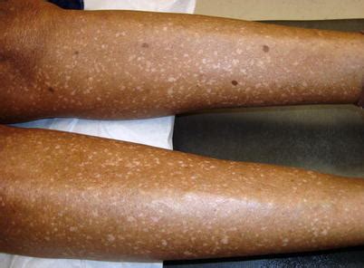 Idiopathic Guttate Hypomelanosis — Viquepedia