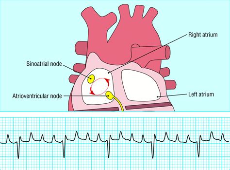 atrial arrhythmias  bmj