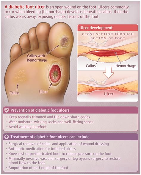 diabetic foot ulcers dermatology jama jama network