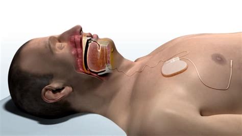 Inspire Spleep Apnea Implant with Valtronic miniaturization - Valtronic