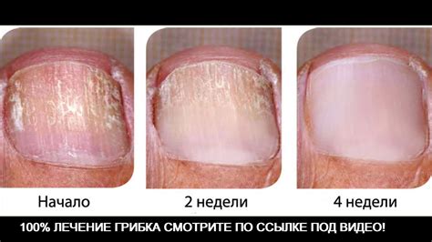 Ноготь после грибка фото (Много фото!) - artshots.ru