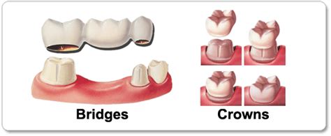 Dental Crowns Henderson NV | Henderson NV Dental Bridges