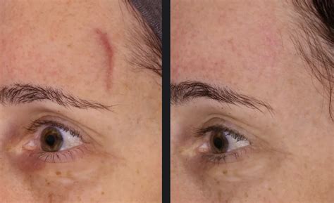 certified aesthetic devices candela