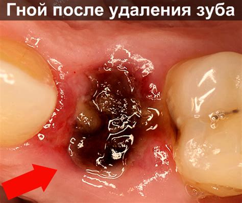 Гной в канале зуба | Взубе.ком