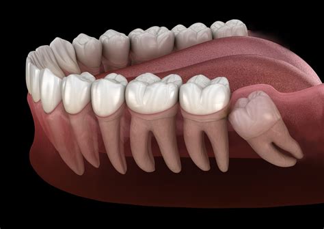 how to get rid of the pain of wisdom teeth 5