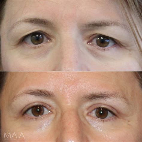 Eyelid Surgery Before And After Photos