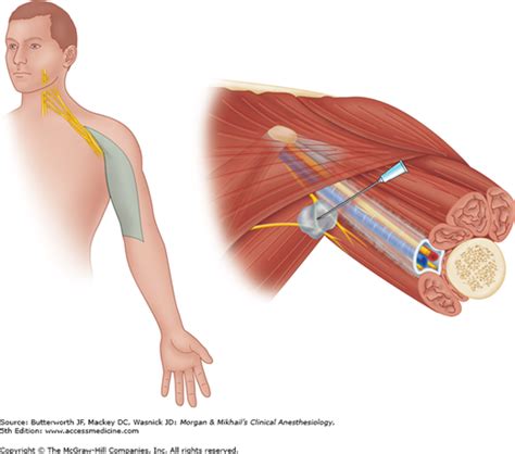 Peripheral Nerve Blocks | Anesthesia Key