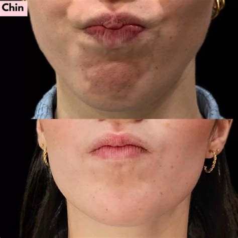 botox  chin dimples  wrinkles  nyc skinly aesthetics medspa