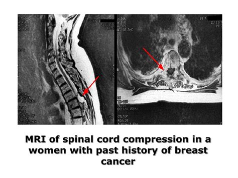 PPT - Recognition & Treatment of Malignant Spinal Cord Compression ...