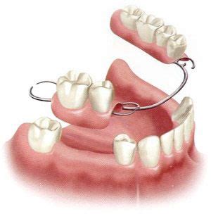 Dental Implants Near Me | Dental Implants Before & After | Partial ...