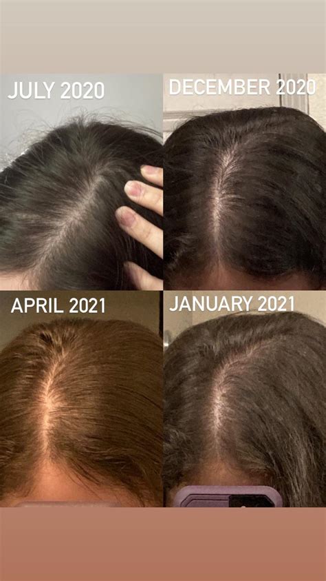 Spironolactone progress? I feel like I’m still shedding : r/FemaleHairLoss