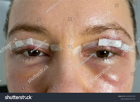 Close Woman Eyes After Plastic Surgery Stock Photo 2241532745 ...