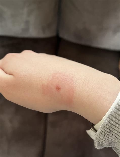 bee sting rmedicaladvice