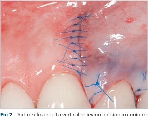 Figure 2 from Wound closure and wound healing. Suture techniques in contemporary periodontal and ...