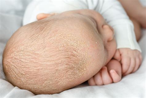Seborrheic Dermatitis SweetCare United States