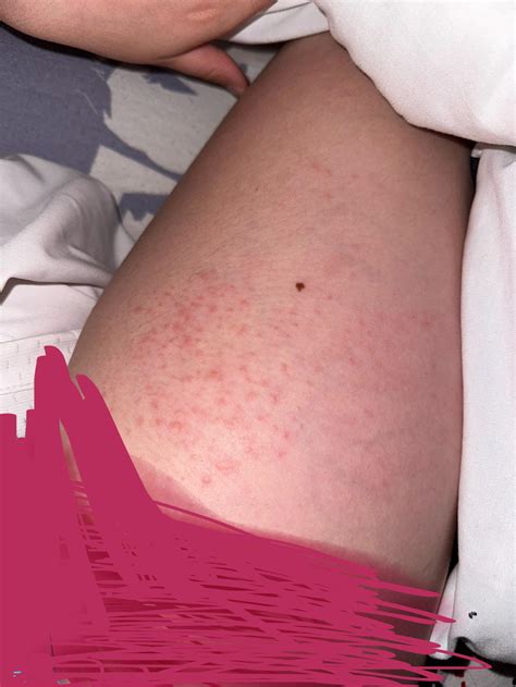 Itchy bumps on outer thighs : r/DermatologyQuestions