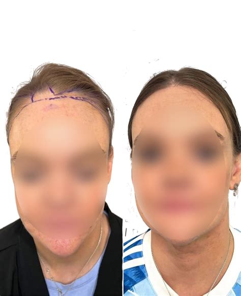 face hair transplant 10