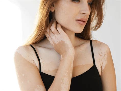 Vitiligo Causes, Treatments, and General Skin Care - Dr. Praneeth Clinic